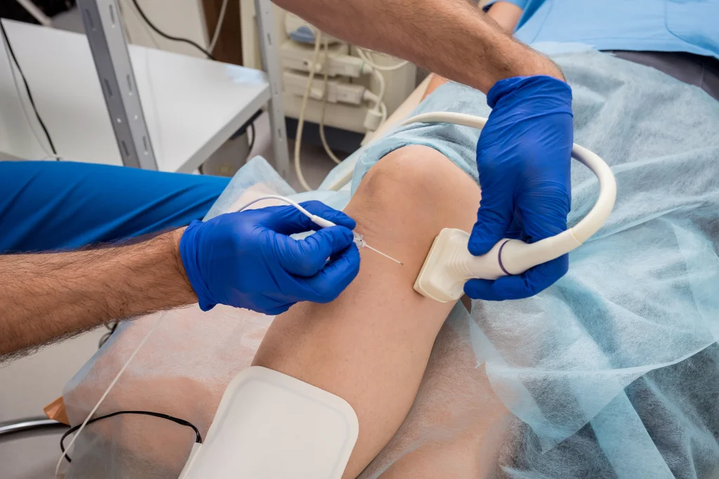 How Does Vein Ablation Procedure Work