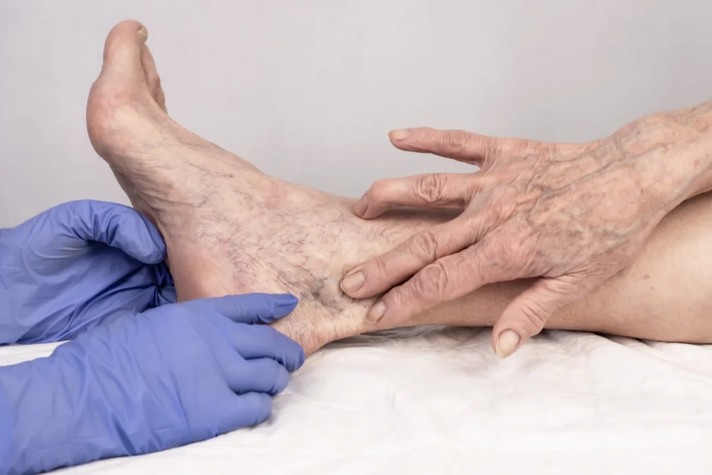 Sclerotherapy Treatment For Spider Veins Sclerotherapy Doctor