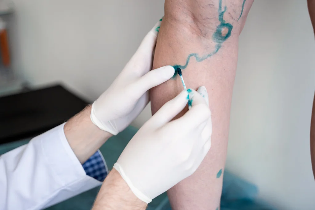 How Professional Vein Mapping Works