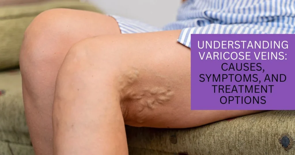 Varicose Veins Causes, Symptoms