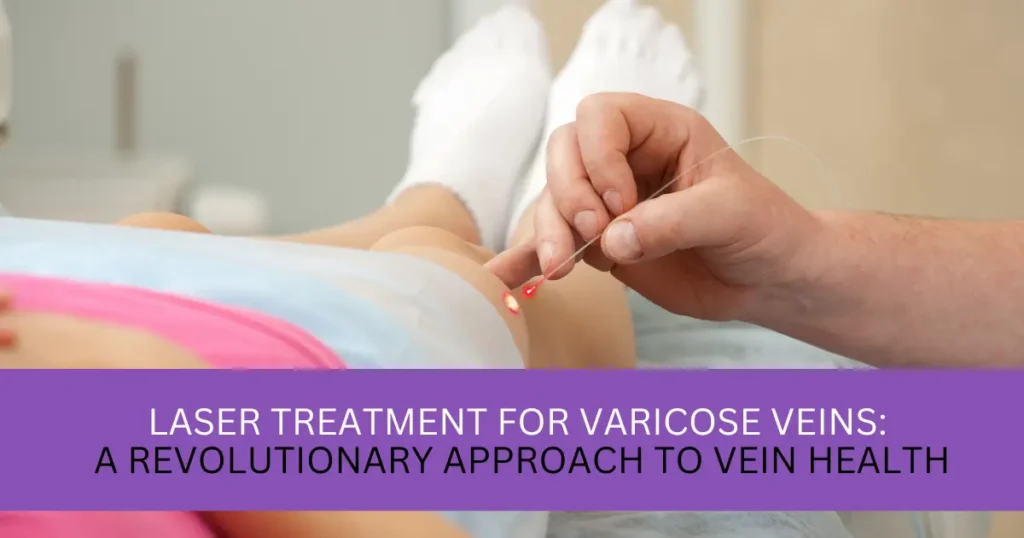 Laser Treatment for Varicose Veins