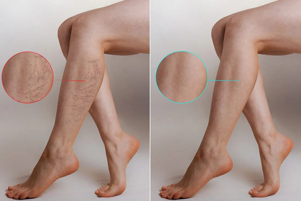 Spider-Vein-Removal-Before-and-After-Care