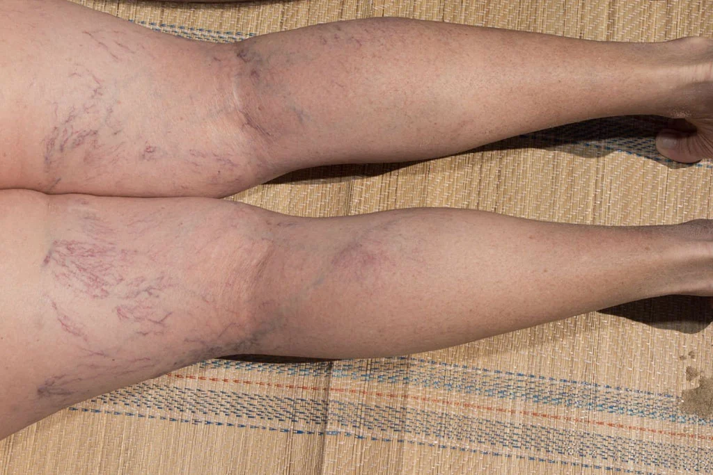 Spider-Vein-Removal-Before-and-After-Care