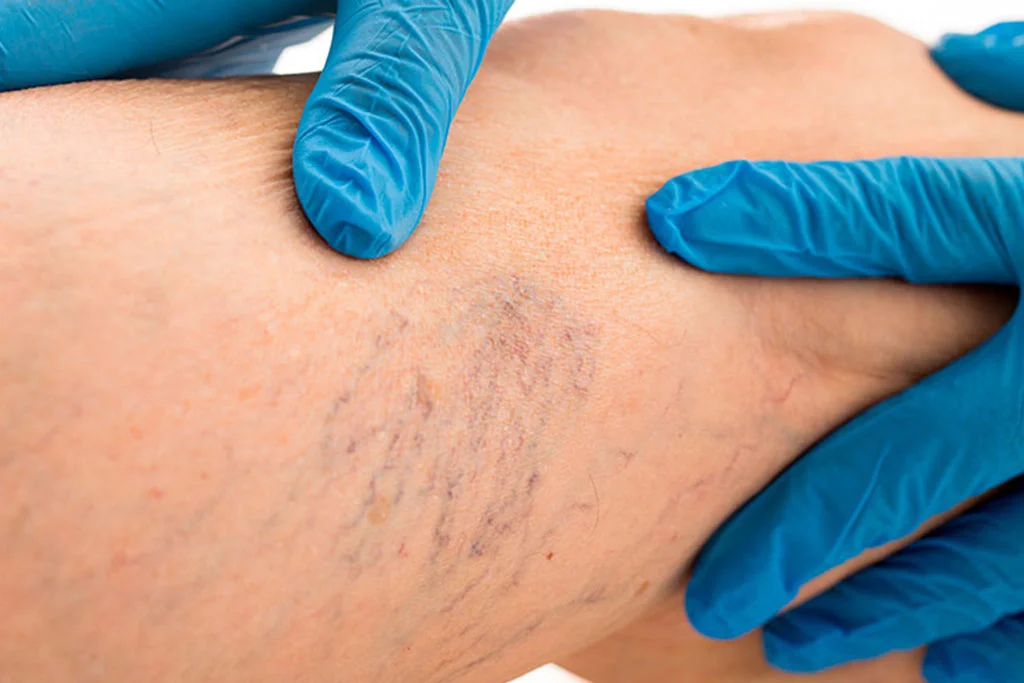 Why-Choose-Our-Spider-Vein-Removal-Treatment