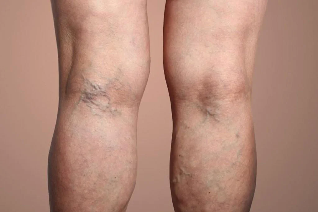 Why-Opt-for-Our-Varicose-Vein-Treatment