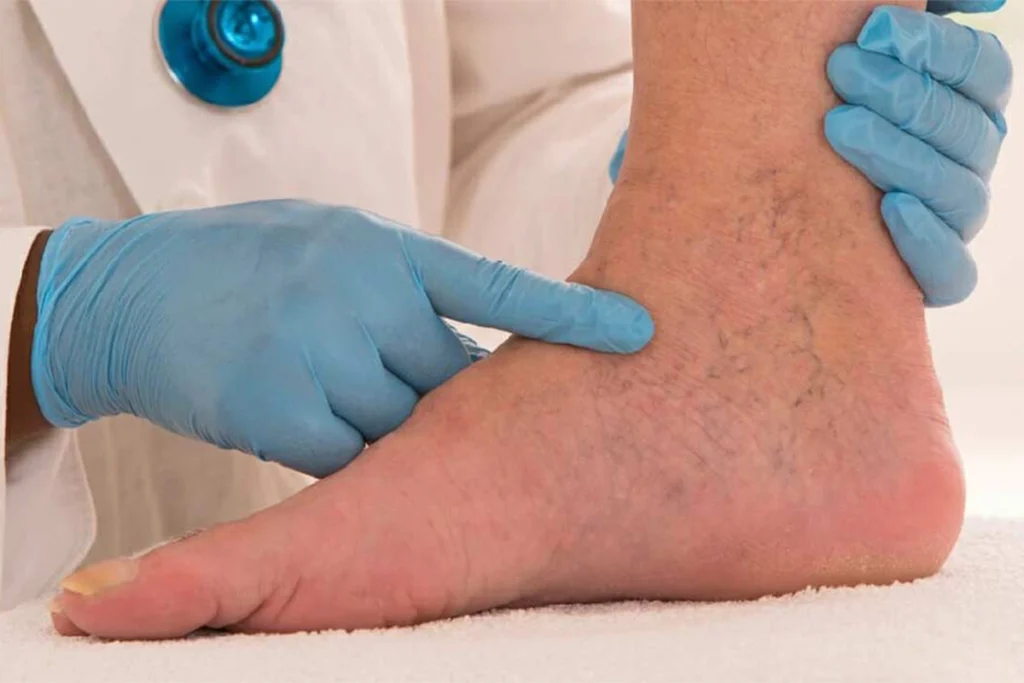 Chronic-venous-insufficiency-(CVI)