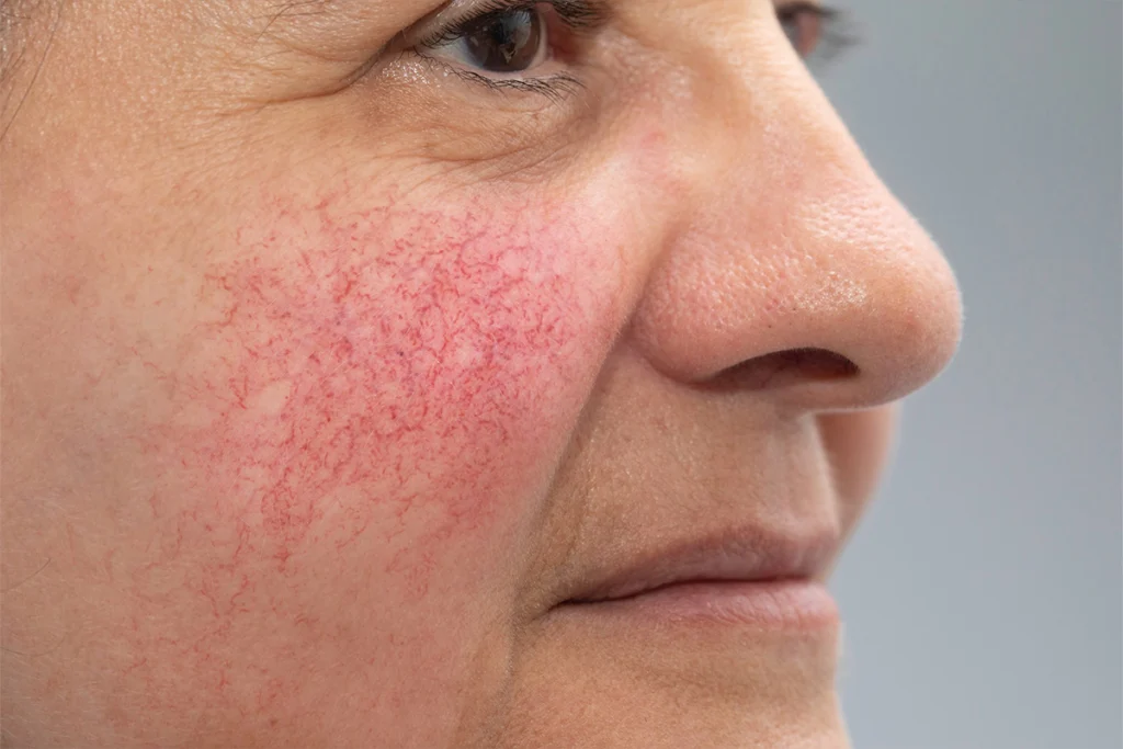 Facial-Veins
