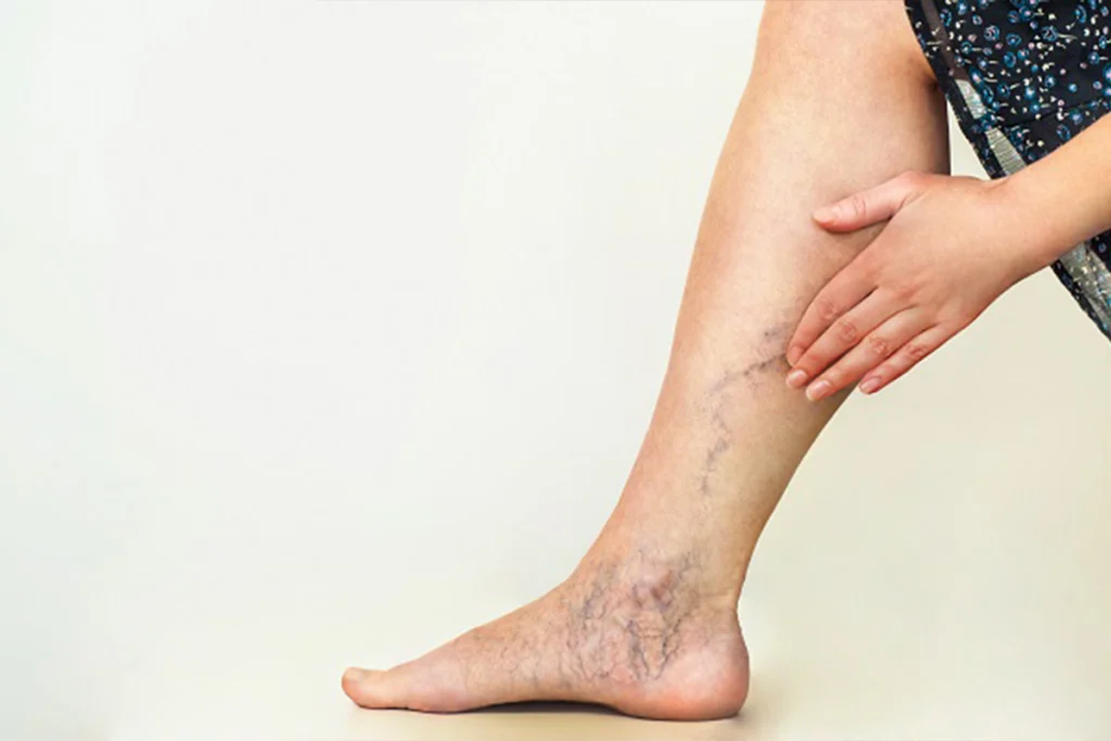 Pregnancy-related-vein-issues