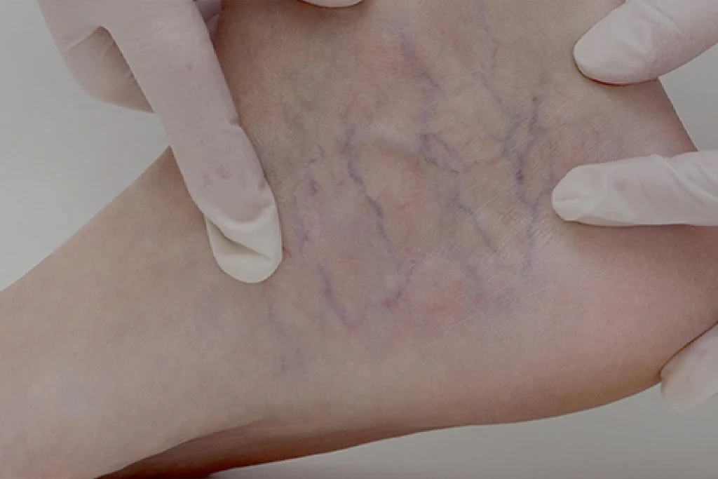 Small-varicose-veins