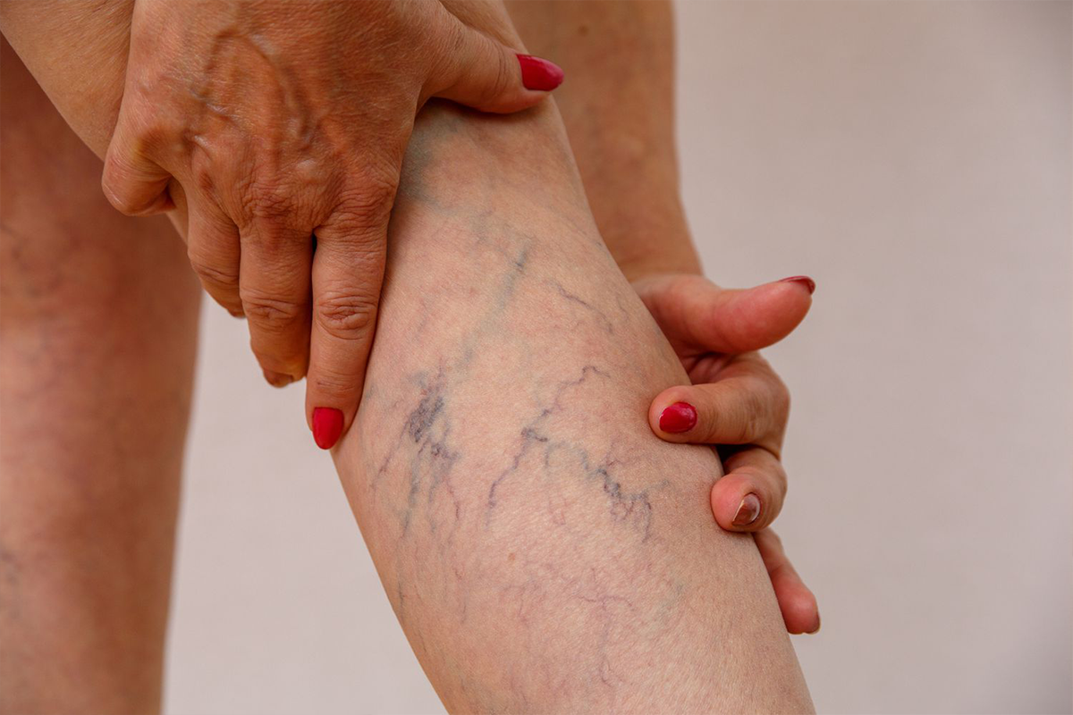 what-are-varicose-veins