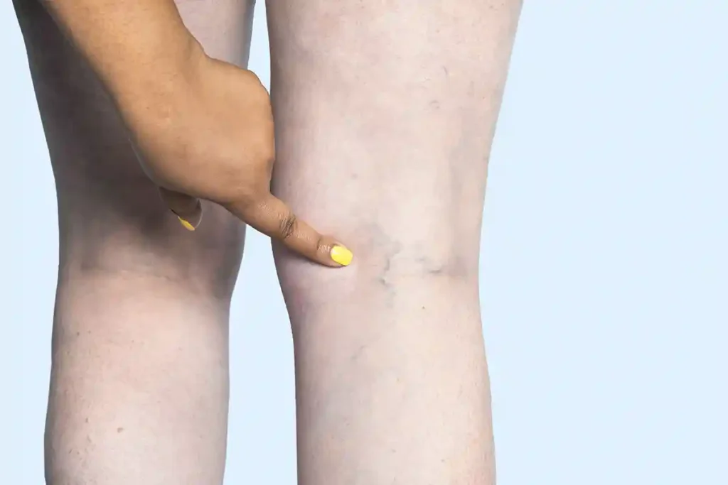 Chronic Venous Insufficiency