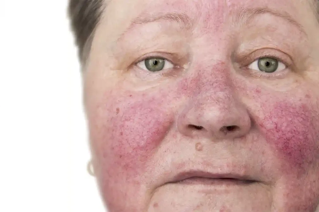 Facial Veins