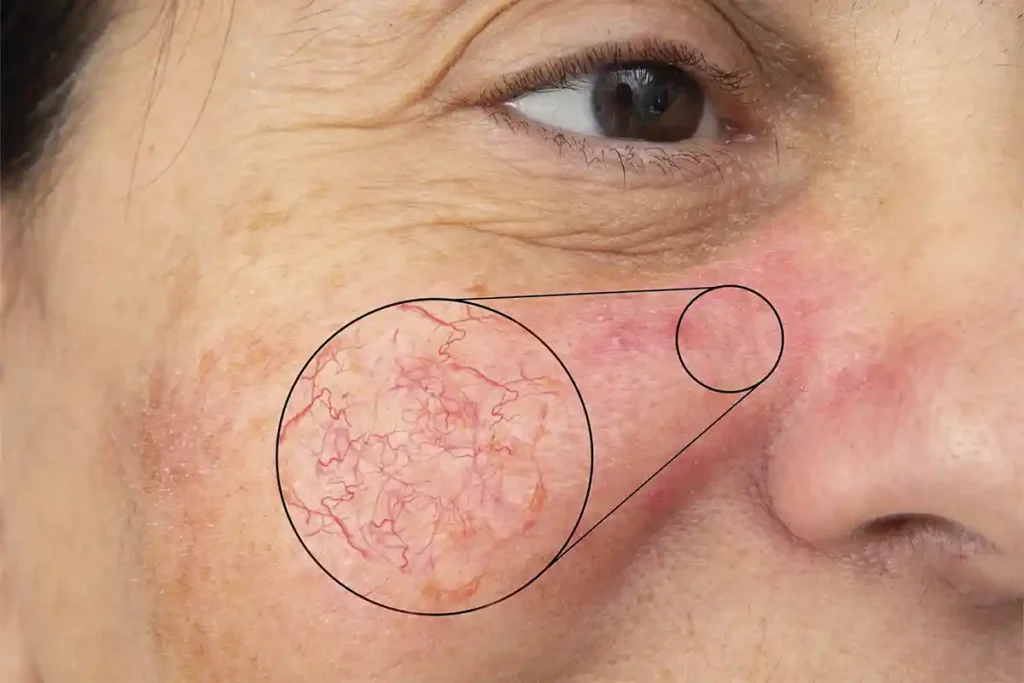 Facial Veins