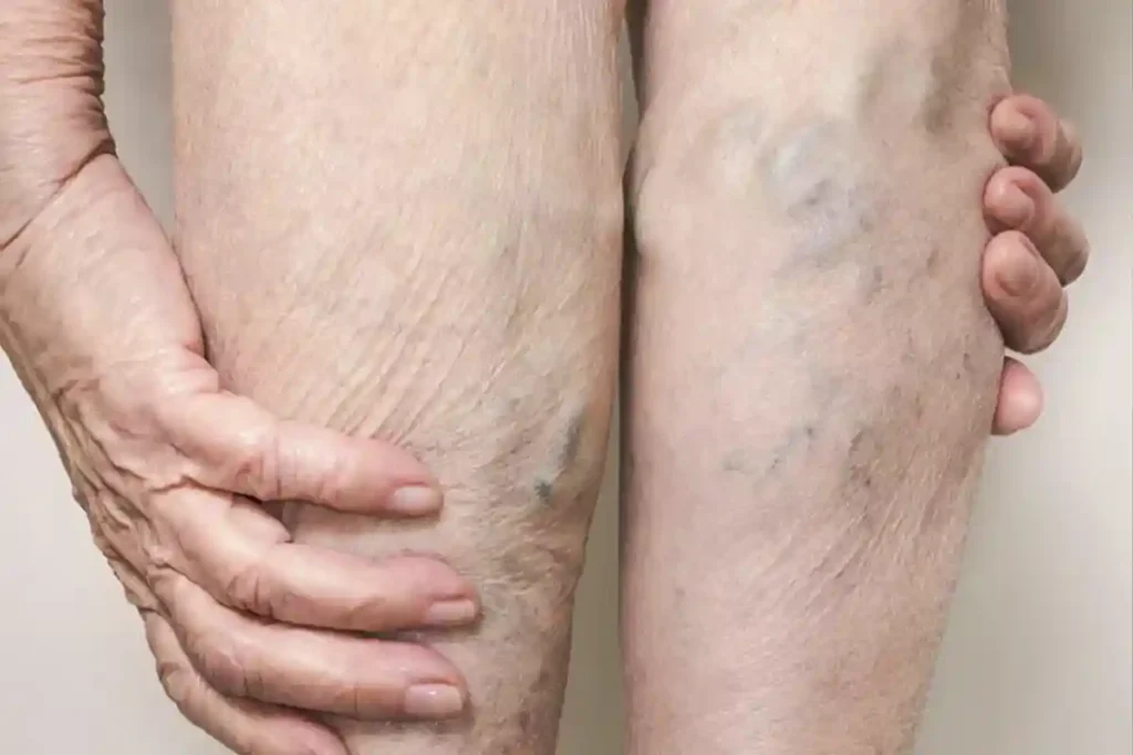 Large Varicose Veins