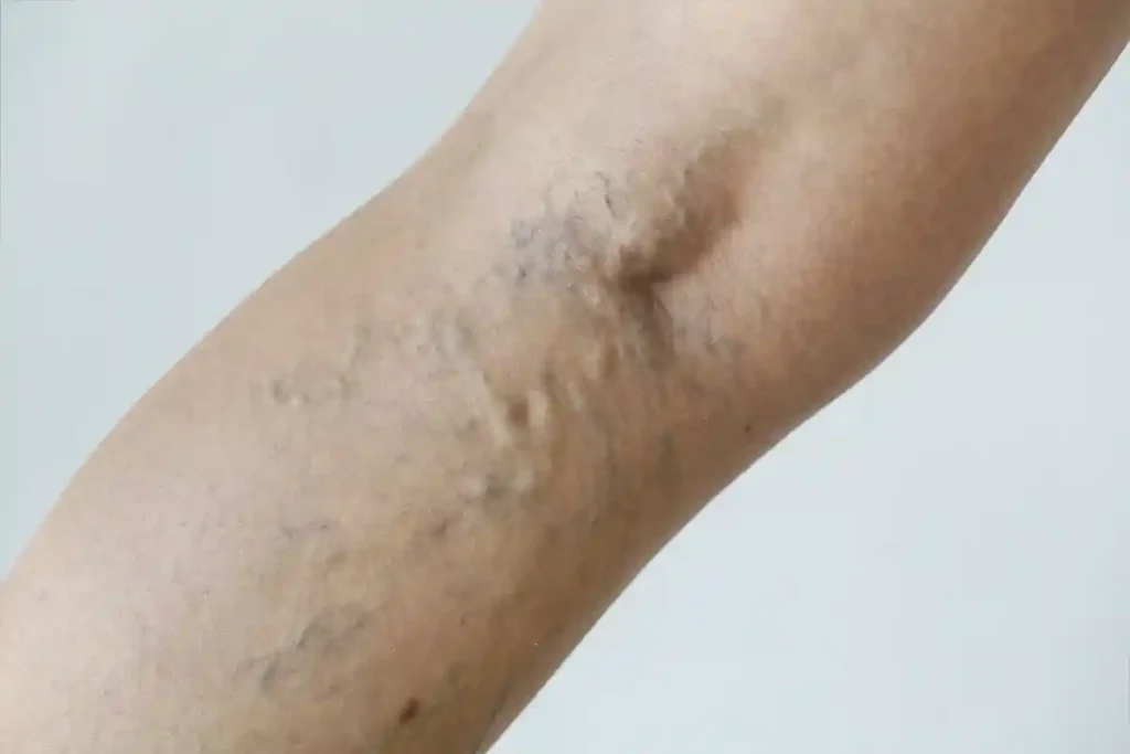 Large Varicose Veins