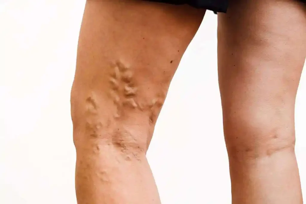 Larger-varicose-veins