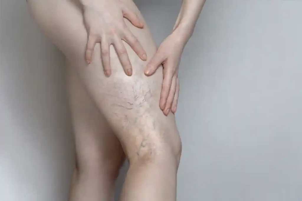 Pregnancy-related Vein Issues