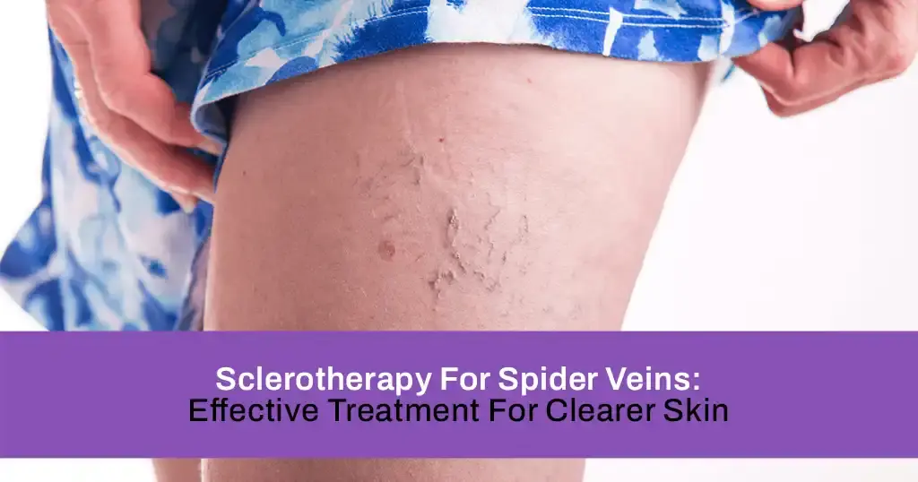 Sclerotherapy For Spider Veins