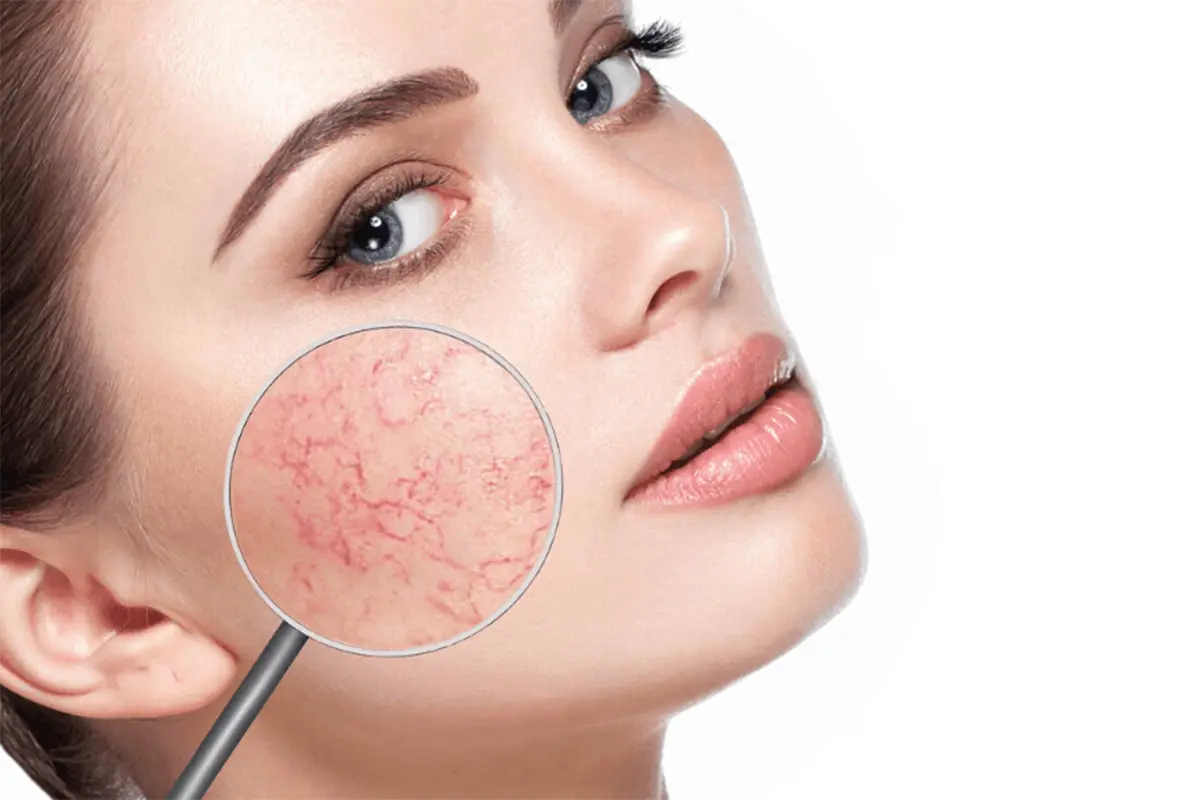 Unwanted Facial Veins