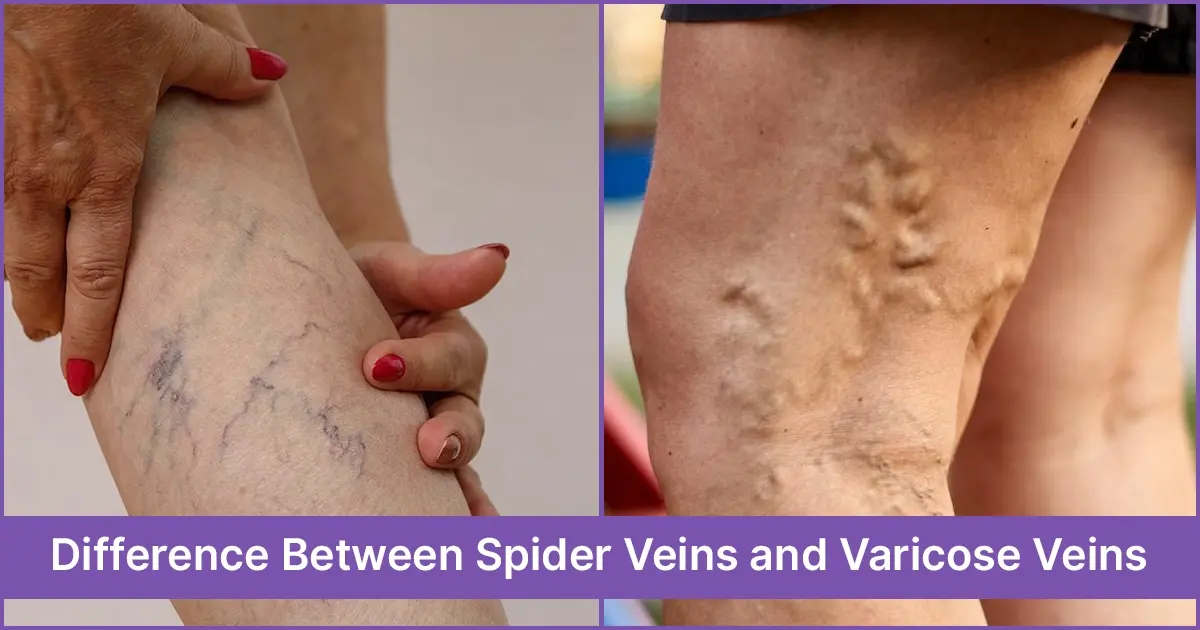 Difference Between Spider Veins and Varicose Veins