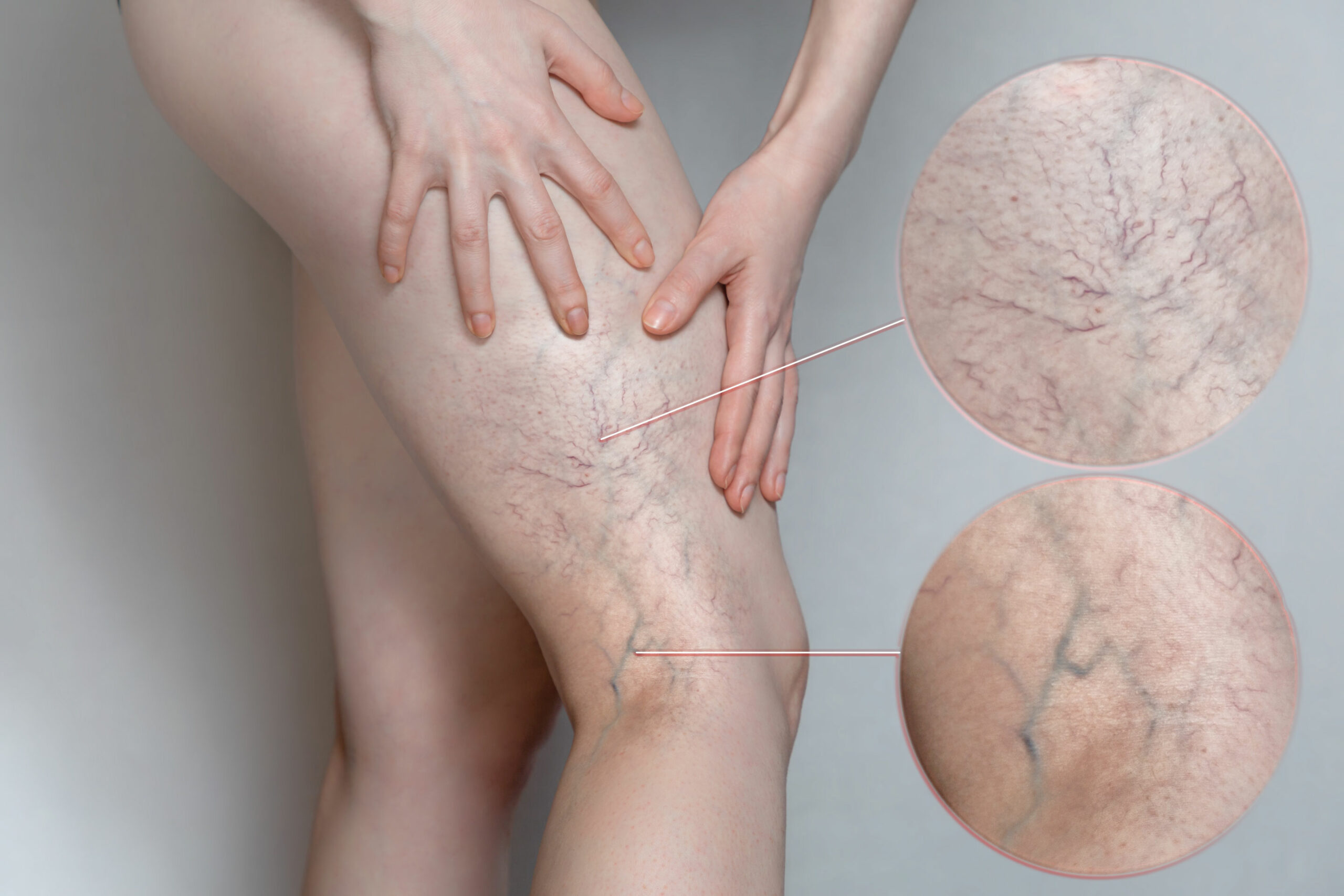 How to Avoid Venous Insufficienc