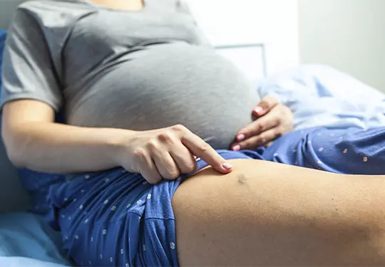 How to Diagnose Pregnancy Related Varicose Veins