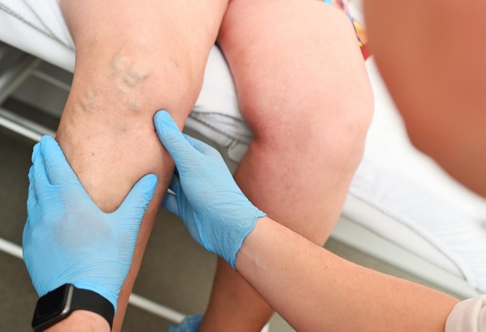 Chronic Venous Insufficiency