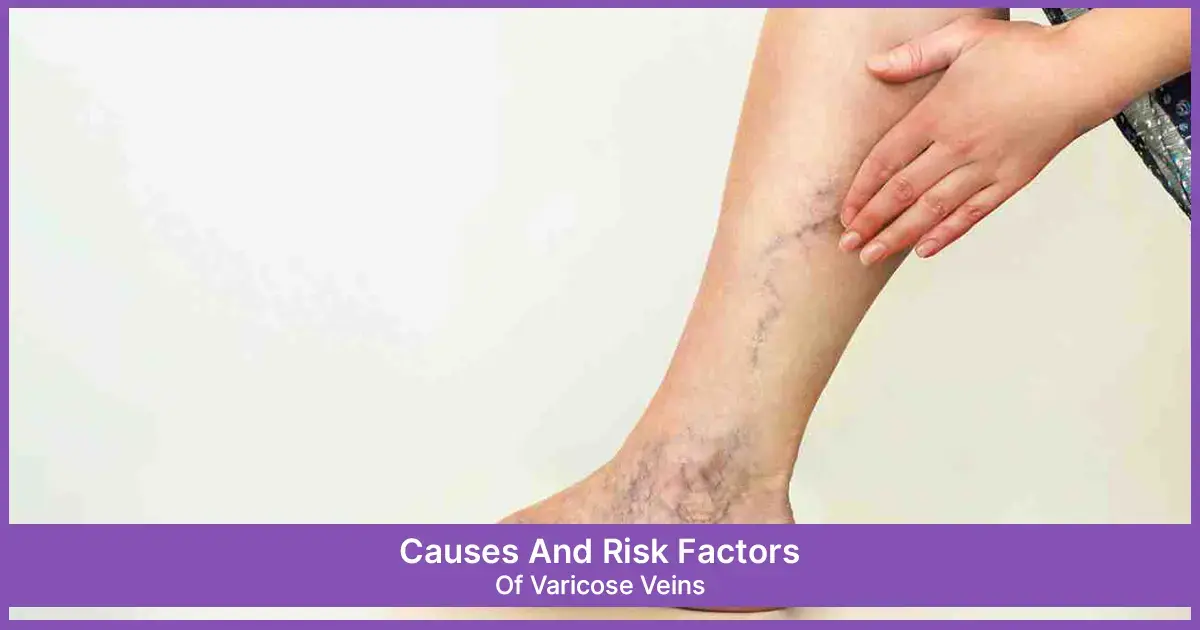 Varicose Veins