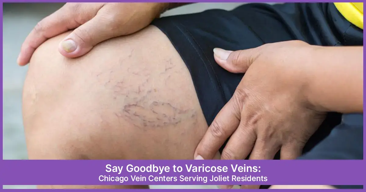 Varicose Vein Treatment Near Joliet