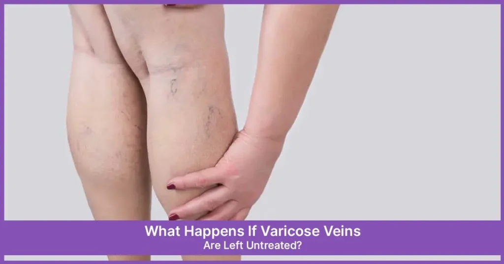 Varicose Veins Are Left Untreated