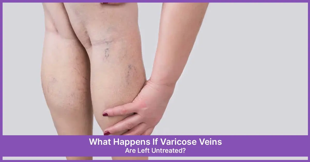 Varicose Veins Are Left Untreated