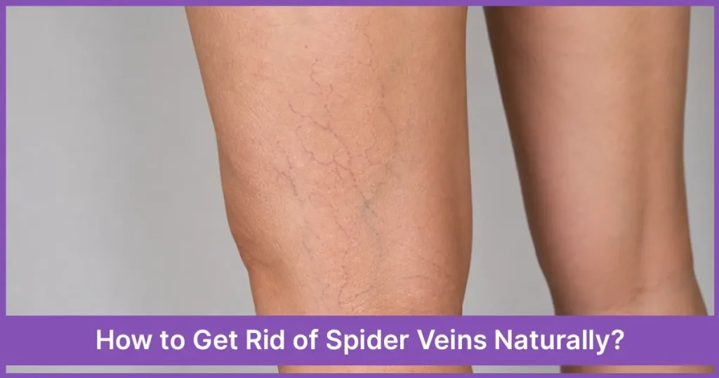 How to Get Rid of Spider Veins Naturally?
