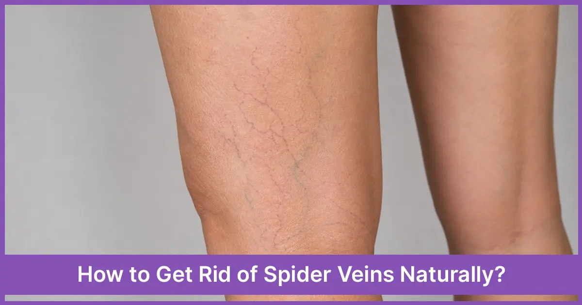 How to Get Rid of Spider Veins Naturally?