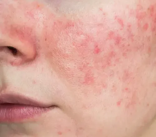 Causes of Facial Spider Veins