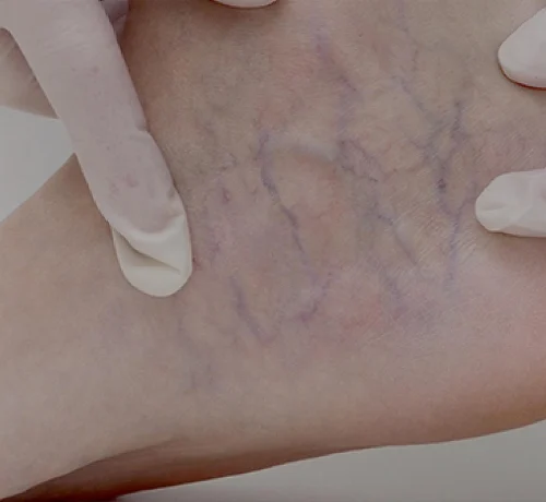 Small-varicose-veins